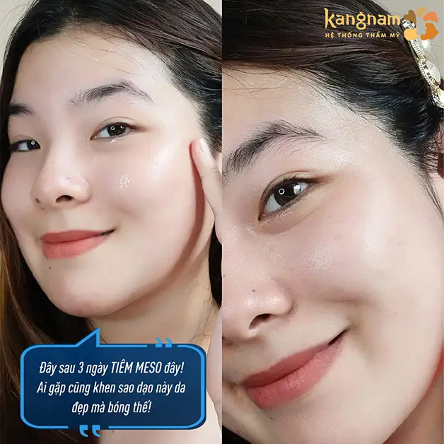 Hình ảnh thực tế của khách hàng sau 3 ngày tiêm meso