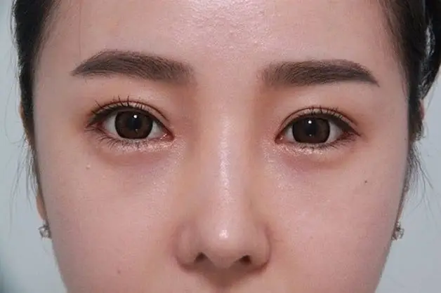 Lấy mỡ mắt sẽ hết sưng sau 5 - 7 ngày