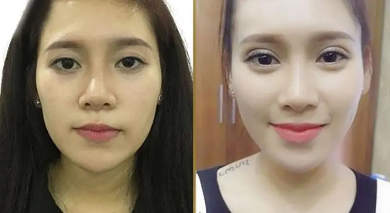 Sau khi mí mắt lành khách hàng sẽ sở hữu đôi mắt tươi trẻ, tự nhiên
