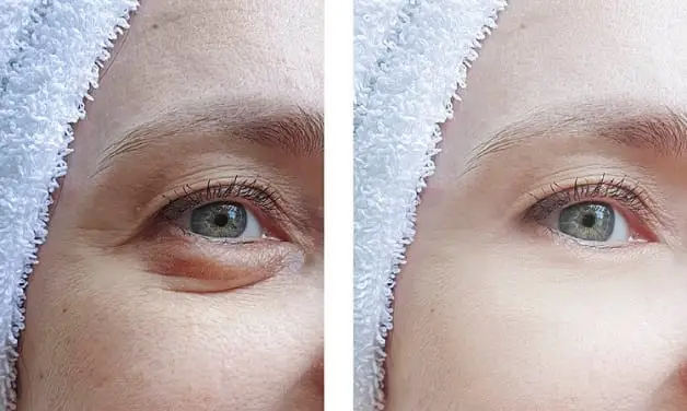 Lấy mỡ mí mắt sẽ phục hồi sau 7 - 10 ngày