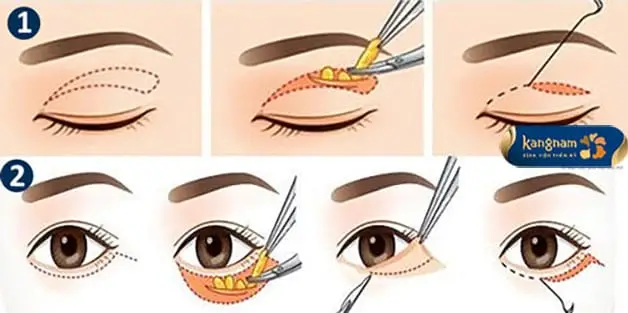 Lấy mỡ mí mắt nội soi là tiểu phẫu đơn giản