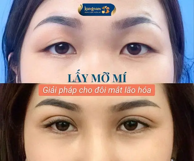 Lấy mỡ mí mắt là tiểu phẫu giúp loại bỏ da chùng, mỡ dư