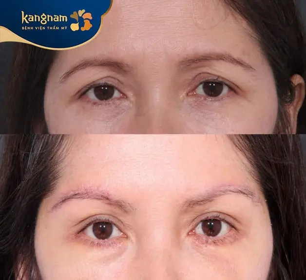 Treo cung mày giúp khắc phục tình trạng sụp mí, chảy xệ chân mày