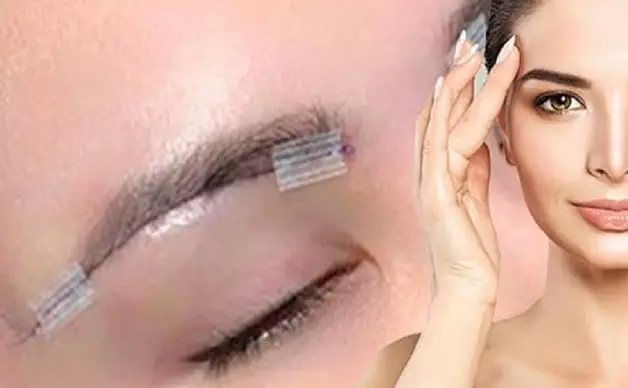 Nâng cung chân mày giấu chỉ sử dụng 4 - 5 sợi chỉ để kéo cao chân mày