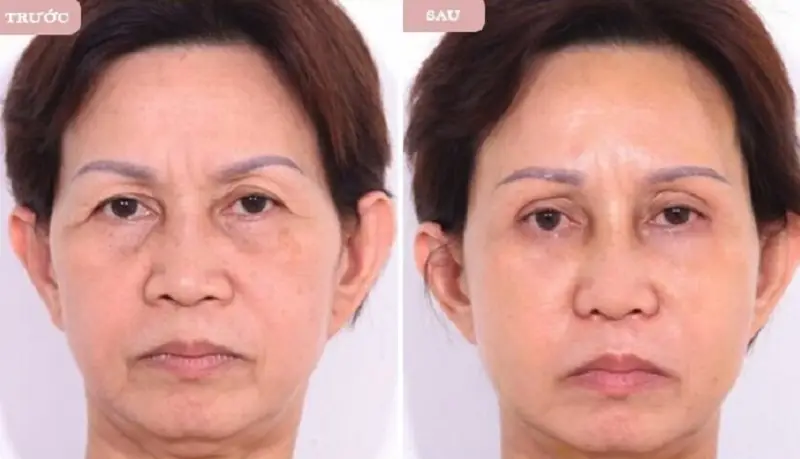 Nâng cung chân mày giấu chỉ giúp khách hàng cải thiện được khuyết điểm chảy xệ, lão hóa