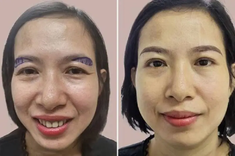 Quá trình phục hồi khách hàng nên kiêng cữ cẩn thận