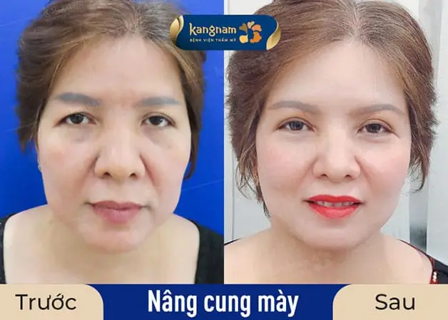 Trên thị trường có nhiều mức giá nâng cung mày khác nhau