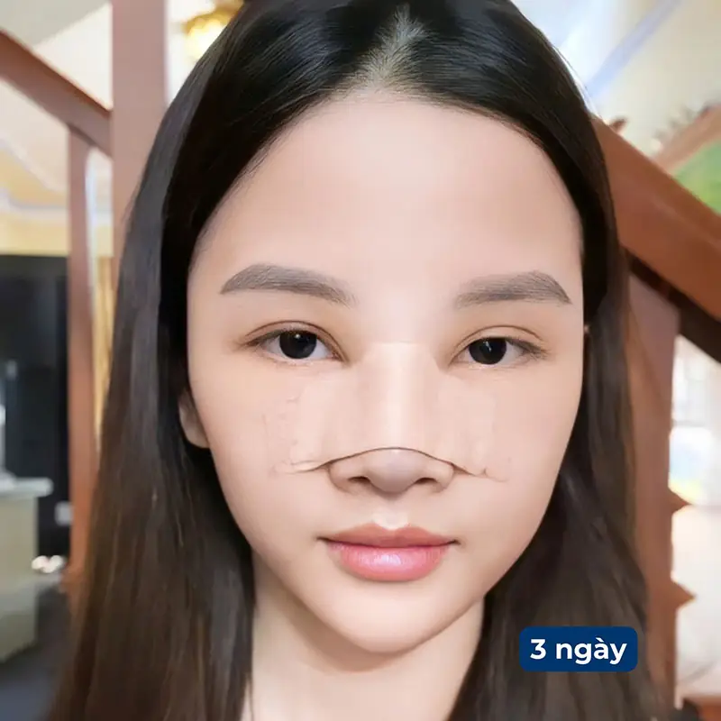 Không tự ý tháo nẹp mũi tại nhà