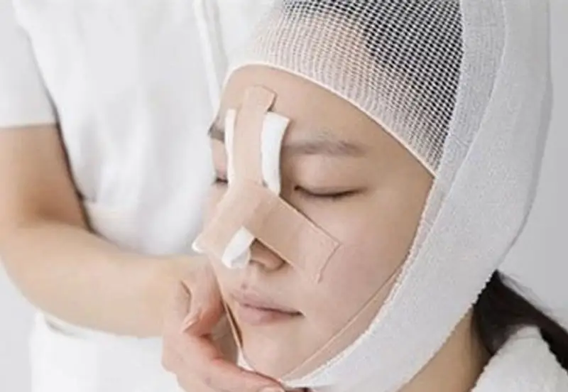 Nâng mũi tháo nẹp sau 1 tuần