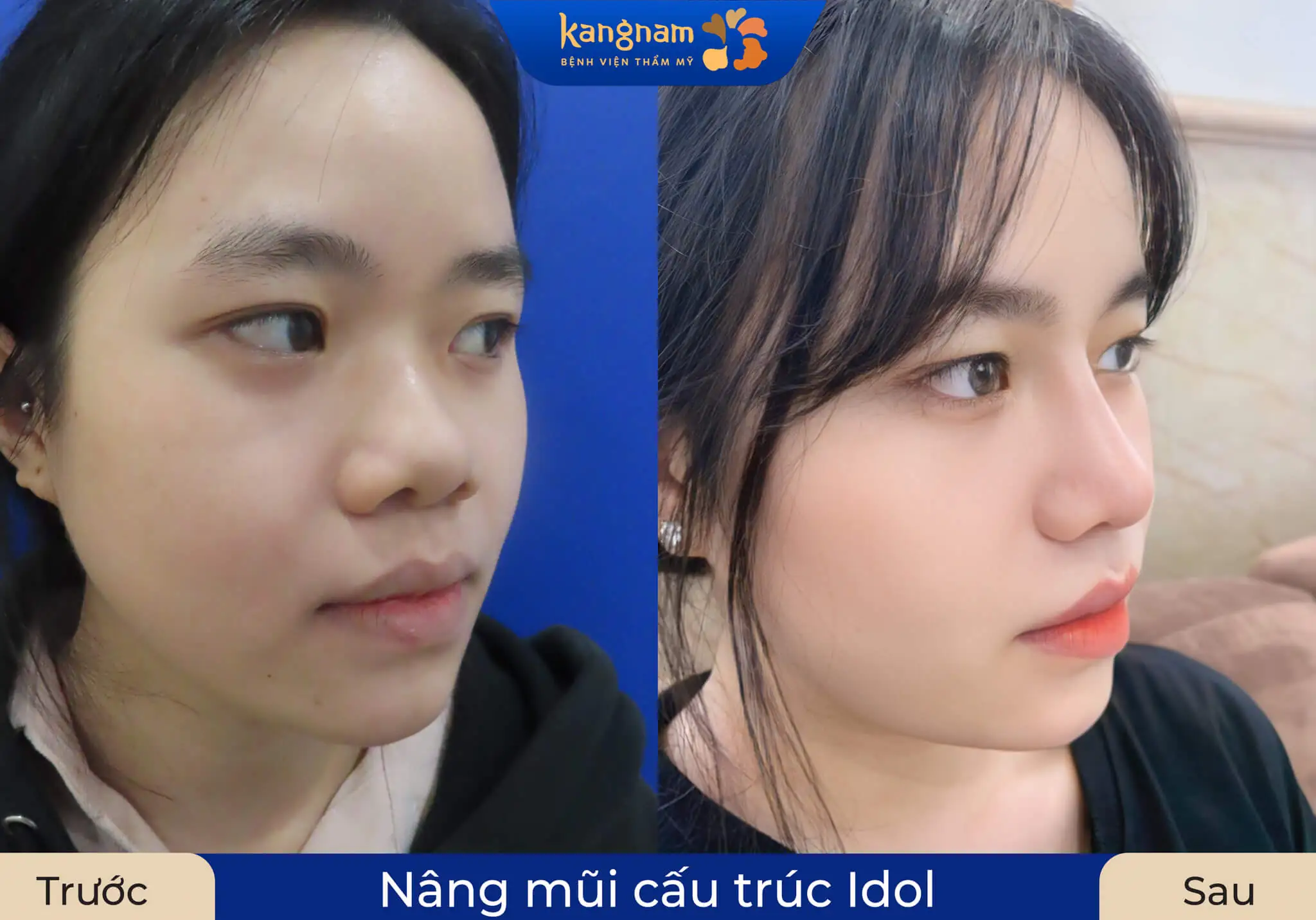 Đầu mũi giọt nước mềm mại, khắc phục tình trạng mũi hếch hay lộ sóng