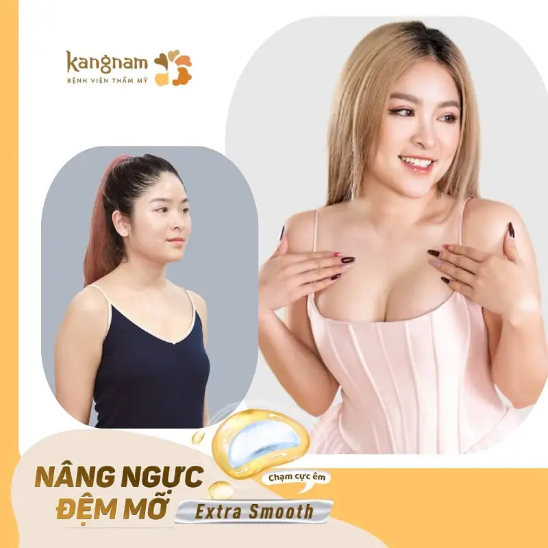 Phương pháp nâng ngực đệm mỡ tạo dáng ngực mềm mại, giảm thiểu nguy cơ biến chứng