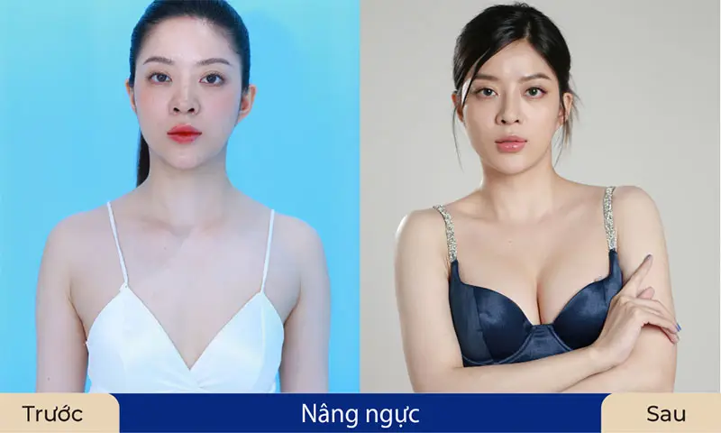 Nâng ngực cải thiện ngực lép sau sinh hiệu quả