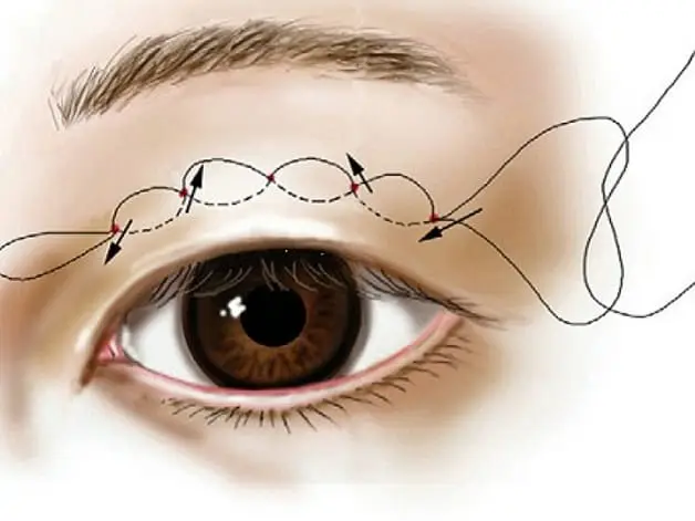 Phương pháp nhấn mí không cần phẫu thuật, bác sĩ sử dụng chỉ sinh học để tạo nếp gấp mí