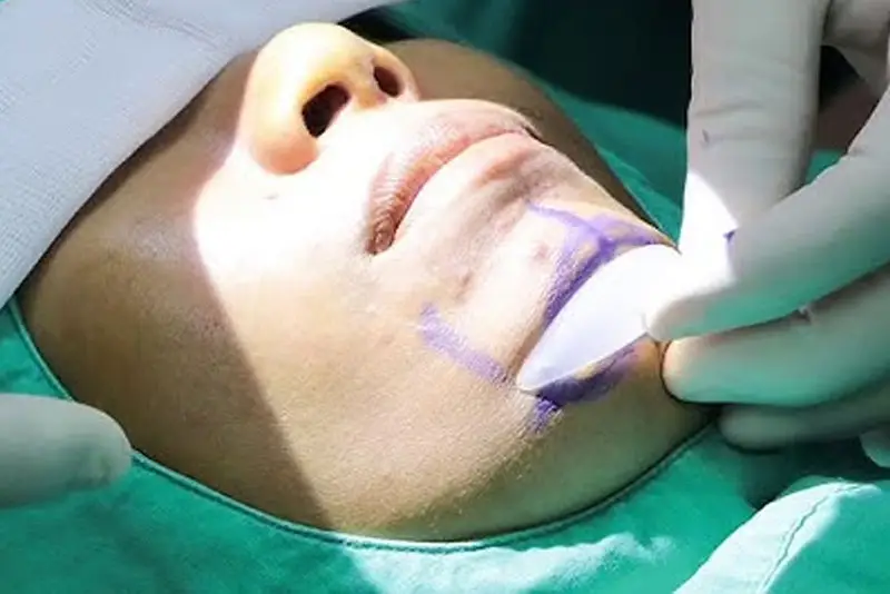 Độn cằm đưa chất liệu độn vào vùng cằm