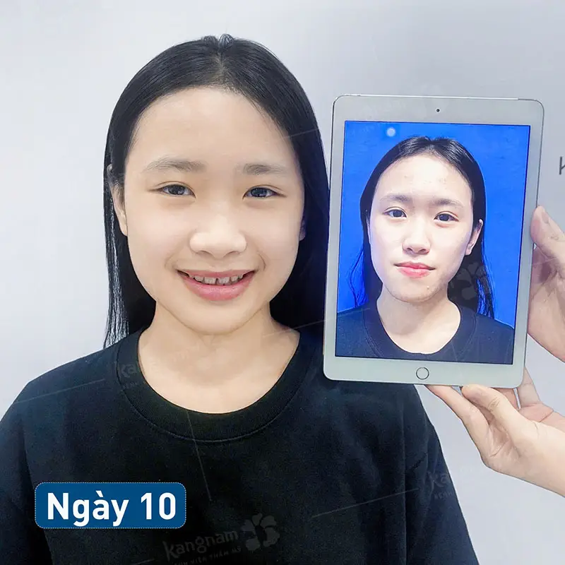 Chỉnh hàm móm sau 2 tuần