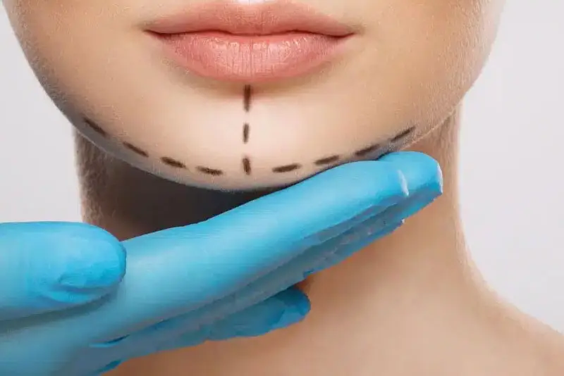 Sưng sau trượt cằm là bình thường