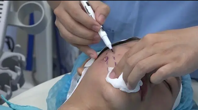 Nhiễm trùng xảy ra khi quá trình căng chỉ không đúng cách