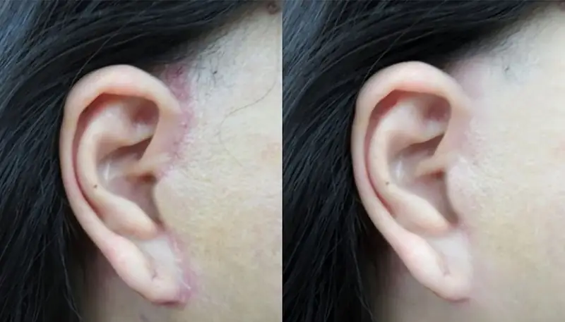 Để lại sẹo vùng mặt nếu không được thực hiện đúng kỹ thuật