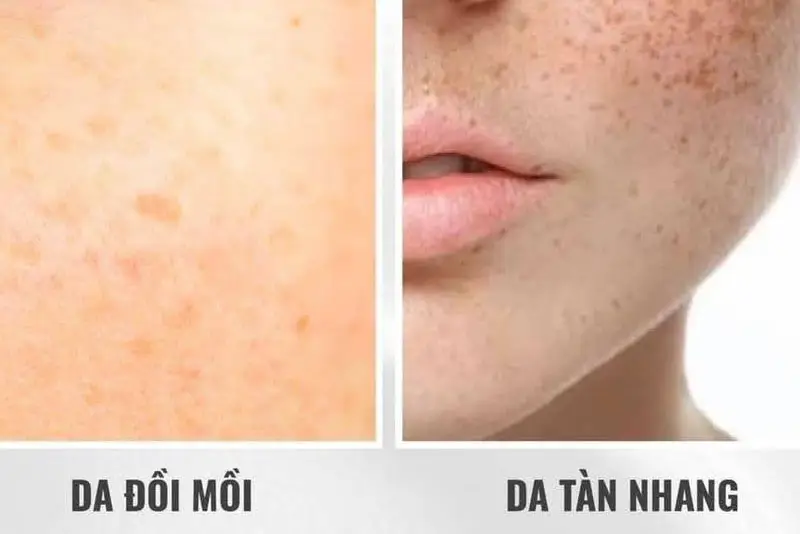 Phân biệt tàn nhang và đồi mồi