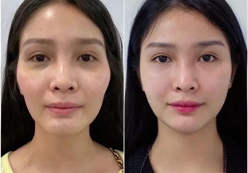 Khách hàng sở hữu khuôn mặt đầy đặn, tươi trẻ hơn sau khi cấy mỡ tự thân