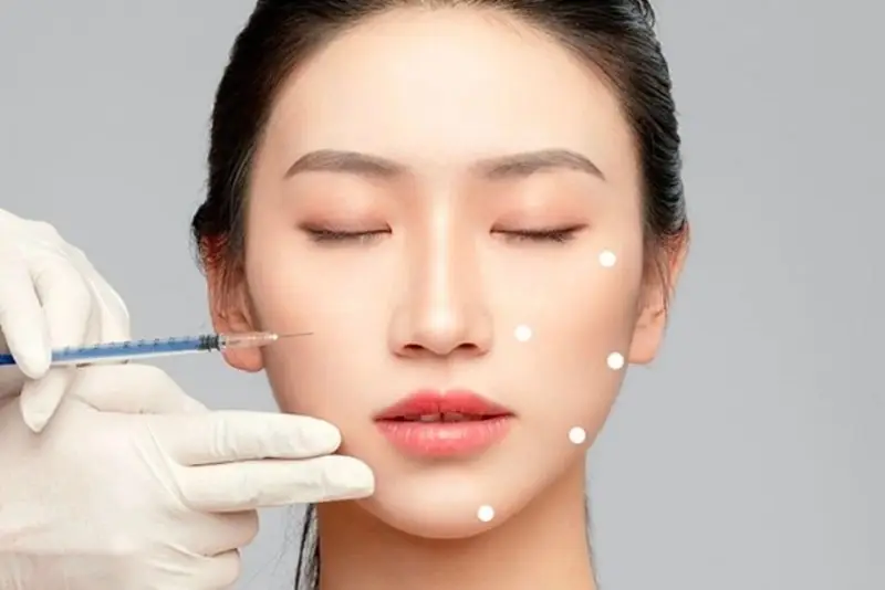 Tiêm filler tan sau khoảng 6-24 tháng