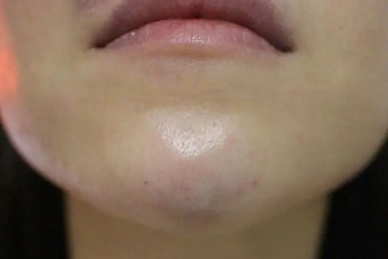 Dị ứng filler có thể khiến cằm bị cứng