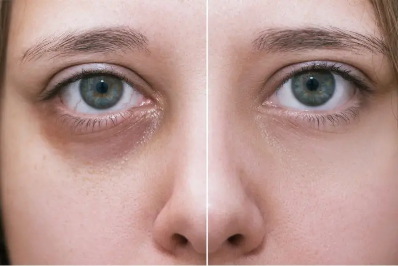 Tiêm filler hốc mắt