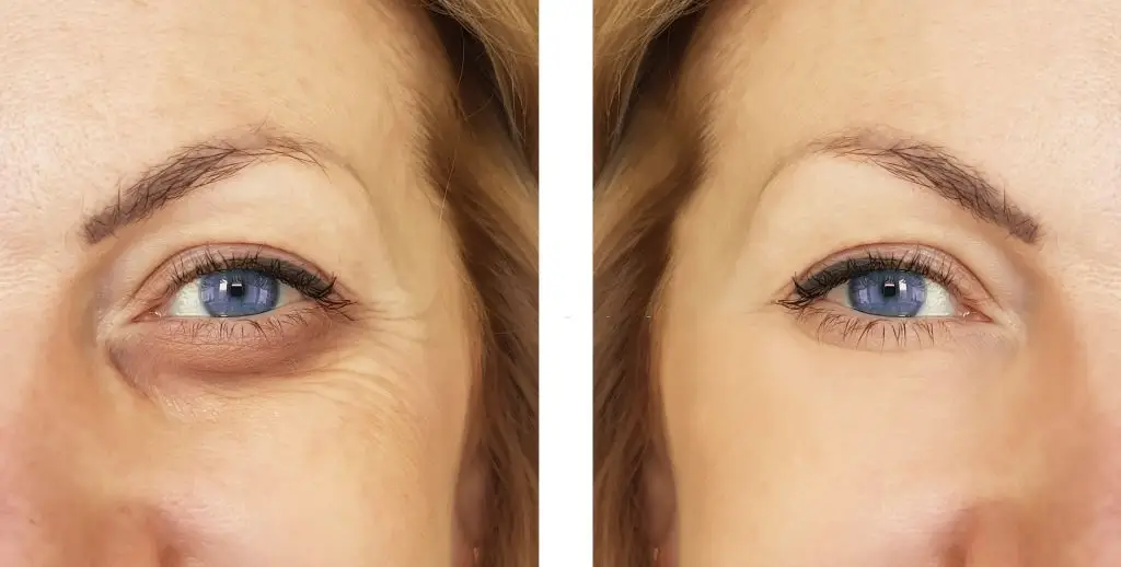 tiêm filler để cải thiện tình trạng hốc mắt lõm