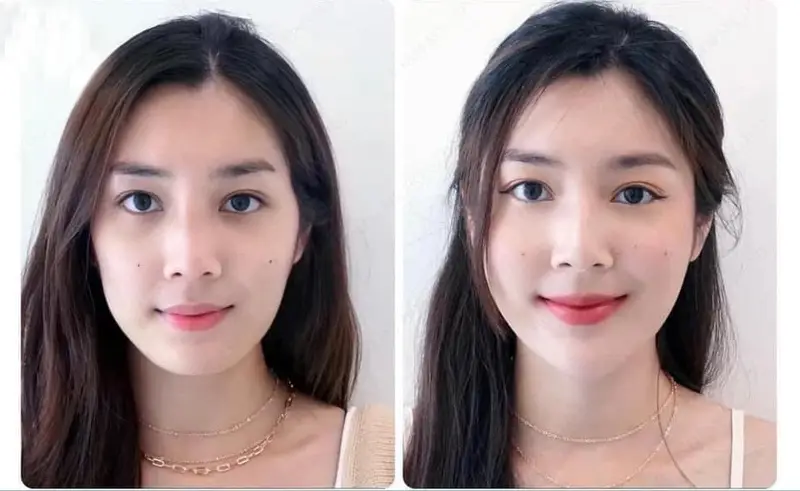 Gương mặt trở nên tươi trẻ, xinh đẹp hơn sau khi tiêm filler 