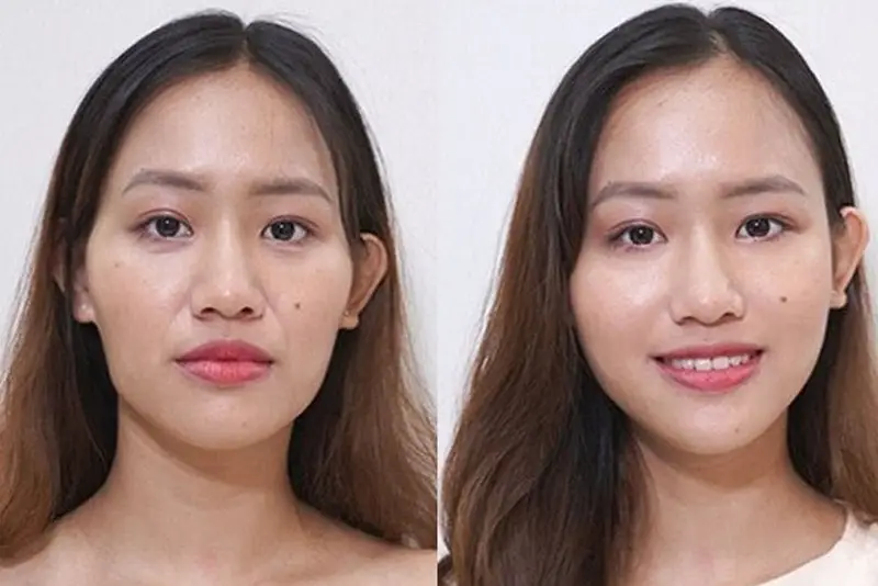 Một bên má cần từ từ 1.5CC đến 2CC