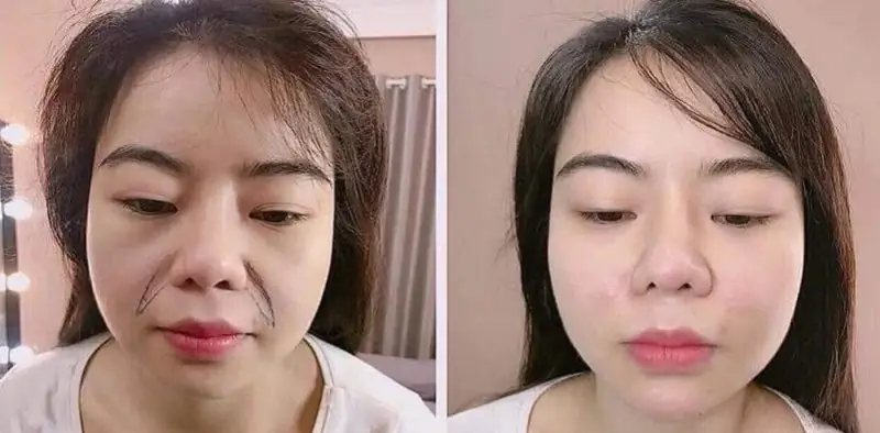 Vùng rãnh cười sẽ hết sưng sau vài ngày