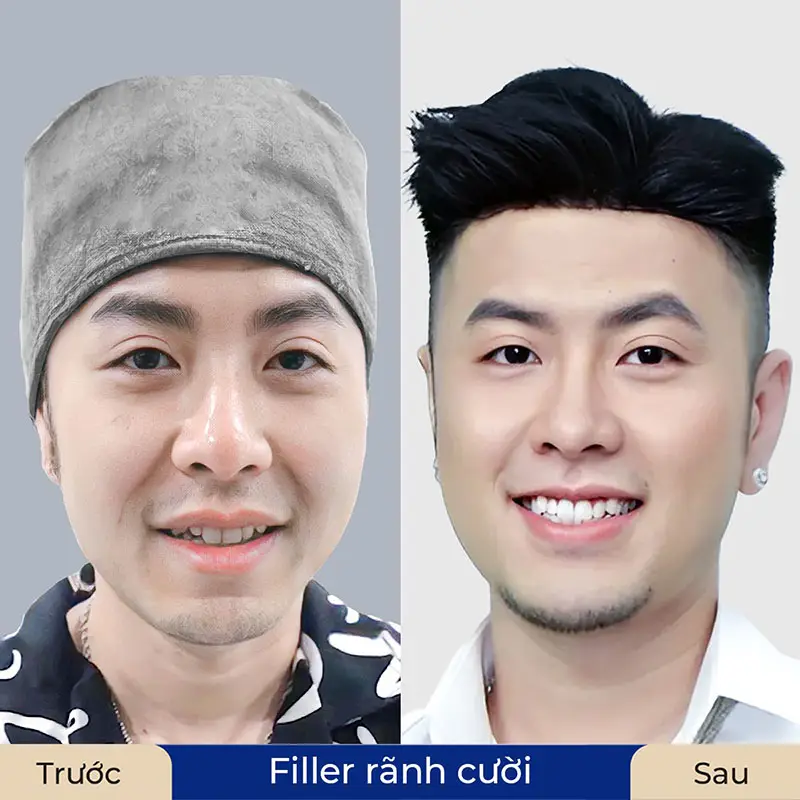 Tiêm filler lấp đầy rãnh cười sâu nhanh chóng