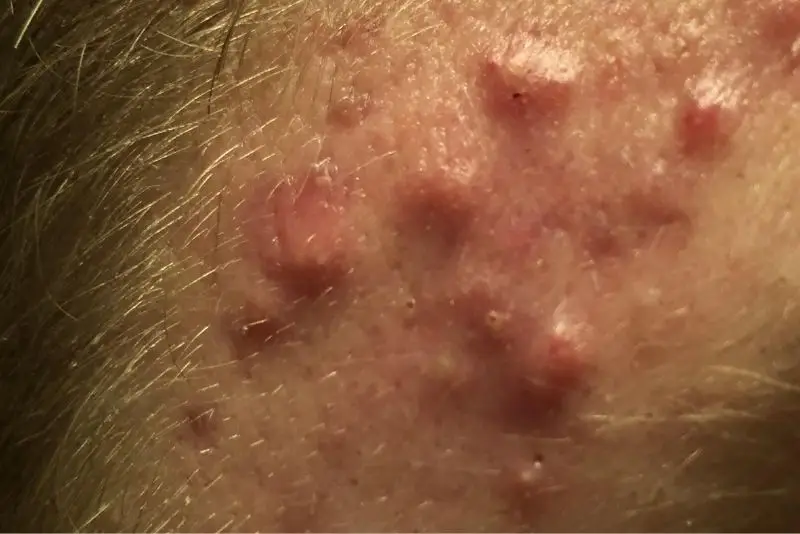 da thái dương đang bị viêm nhiễm