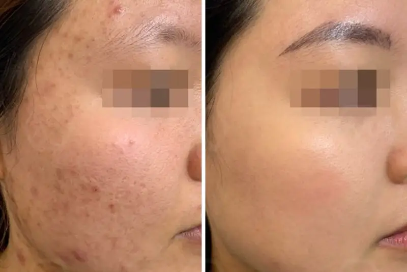 Hết mụn sau 1 liệu trình meso