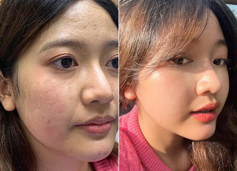 Khách hàng sở hữu khuôn mặt sáng mịn, sạch mụn sau khi tiêm meso