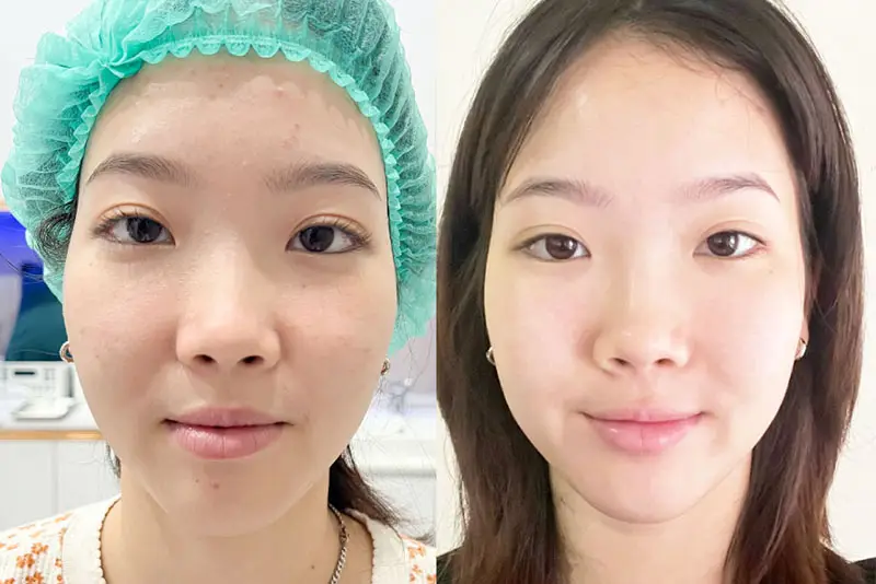 Tiêm meso cải thiện độ căng bóng cho da