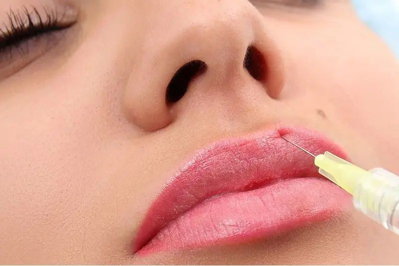 Tiêm tan filler hết sưng sau 2-3 ngày