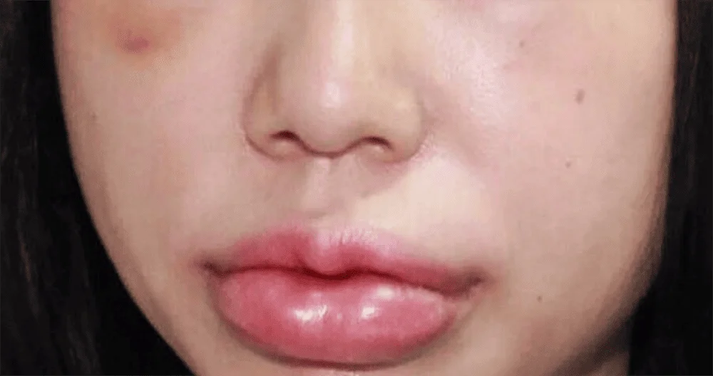 Tình trạng sưng tấy khi mới tiêm tan filler