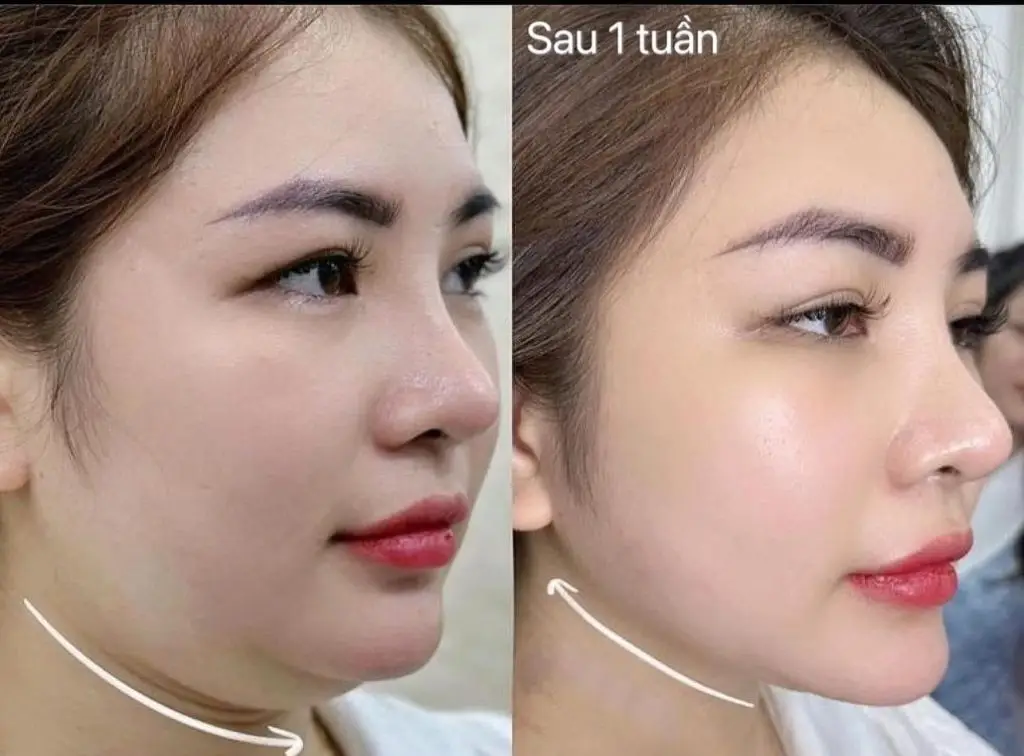 Cằm thọn gọn sau khi tiêm tan mỡ nọng cằm 1 tuần 