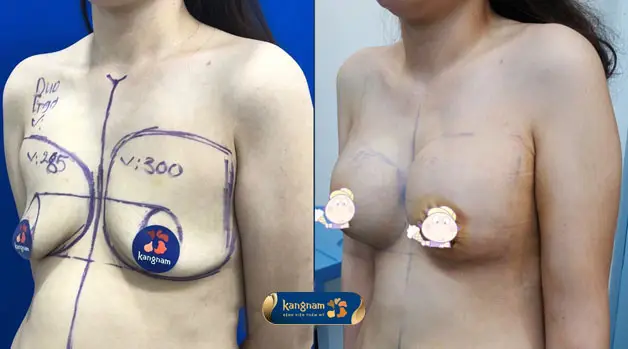 Chăm sóc tốt giúp bầu ngực ổn định và tự nhiên