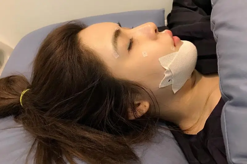 Tổn thương dây thần kinh nếu trượt cằm sai kỹ thuật