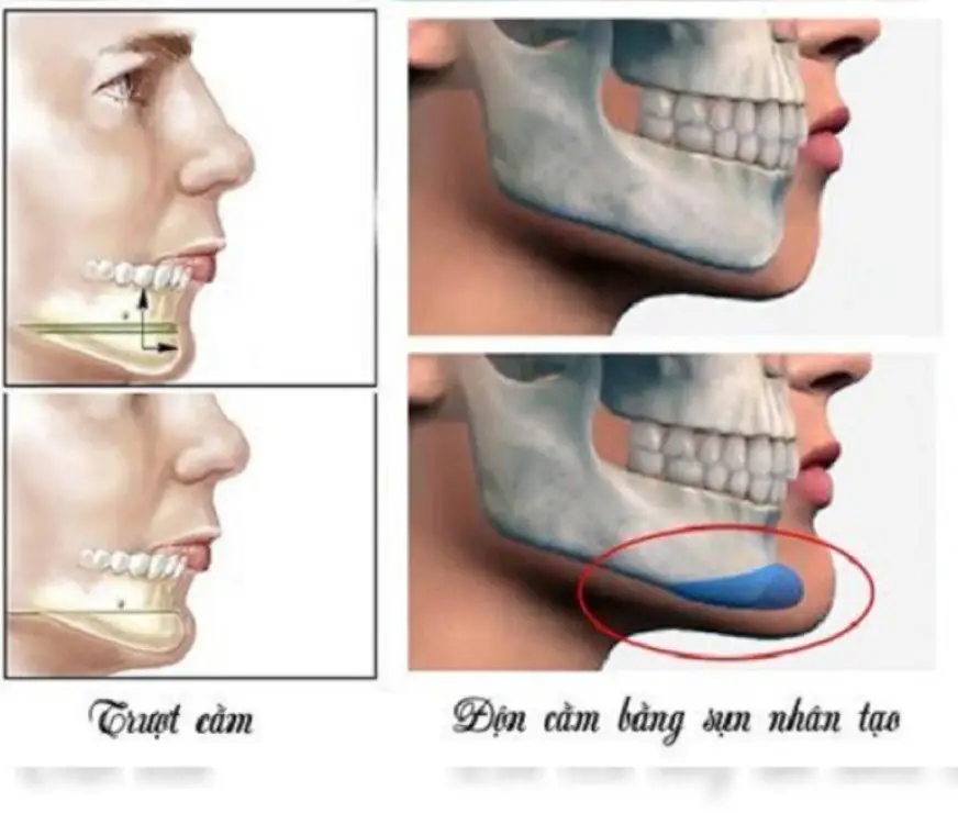 Hình ảnh mô phỏng sự khác biệt giữa trượt cằm và độn cằm Hình ảnh mô phỏng sự khác biệt giữa trượt cằm và độn cằm