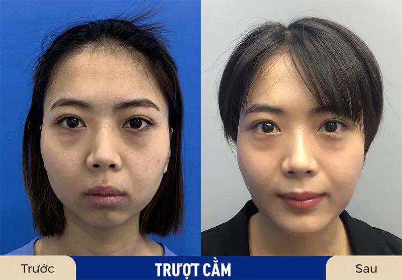 Trượt cằm giúp khuôn mặt cân đối, hài hòa hơn 
