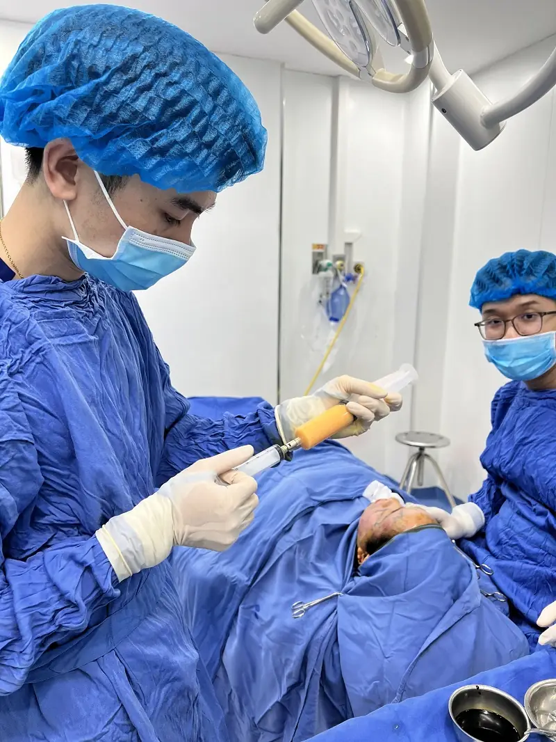 Xử lý mỡ đúng cách sẽ giúp duy trình tỷ lệ sống của mỡ sau cấy