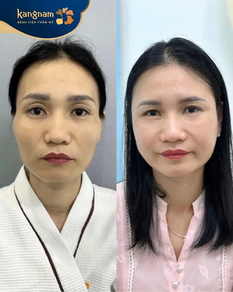 Khách hàng sở hữu gương mặt đầy đặn, cân đối sau cấy mỡ