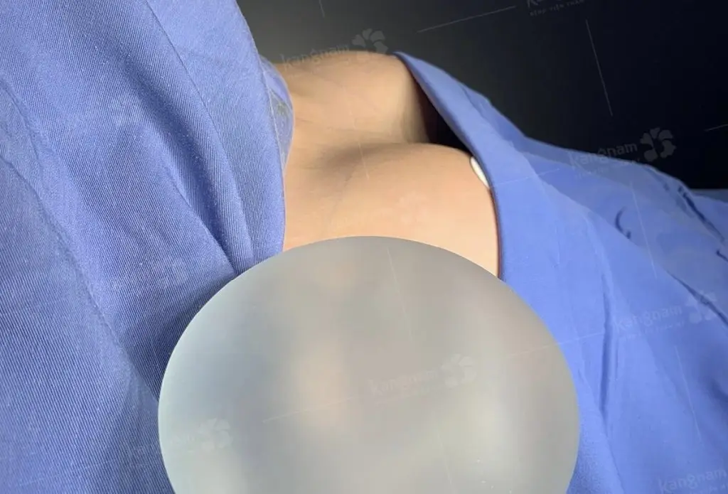 Túi ngực Nano Chip được nhiều người ưa chuộng vì có độ bám dính cao, hạn chế bao xơ