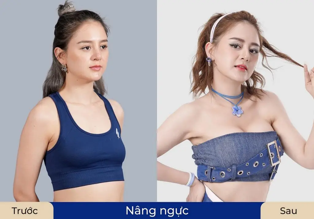 Hot tiktoker Thủng Long Family nâng ngực túi mentor tại Kangnam