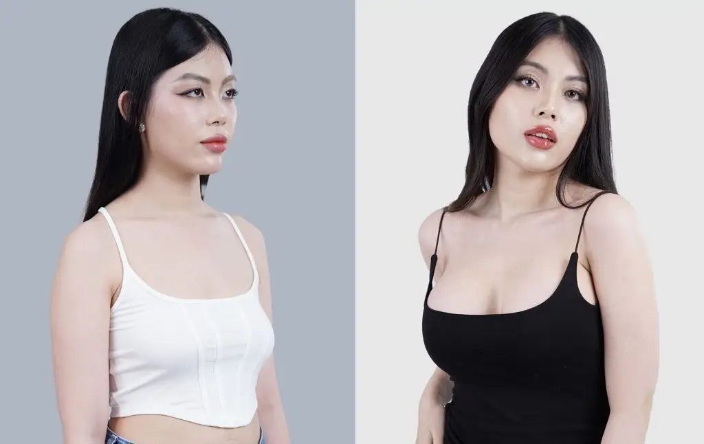 Nâng ngực túi nano chip tạo dáng ngực tròn đầy, quyến rũ