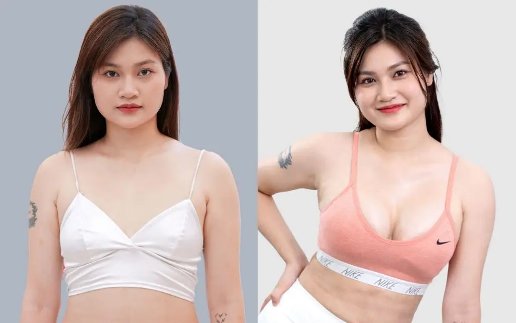 Túi ngực Mentor Etra tạo dáng ngực mềm mại ngay sau khi làm