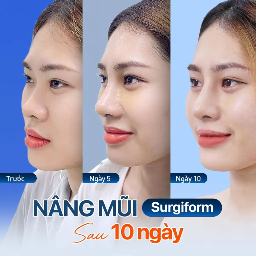 Nâng mũi sụn surgiform giúp khách hàng có dáng mũi tự nhiên, bền đẹp